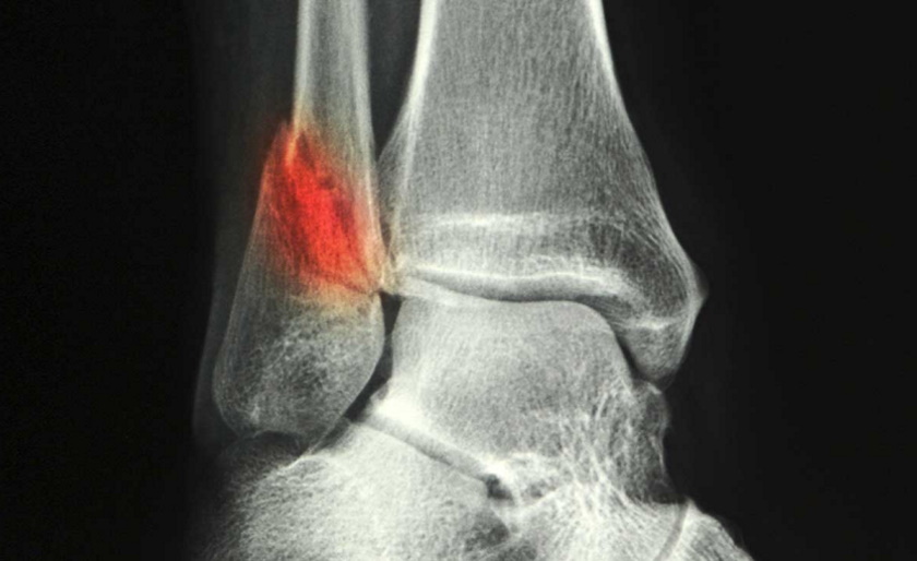 11402-broken_ankle_fracture_side_view-1296x728-slide2