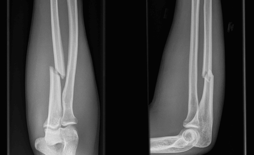 Ulna-Fracture-Nightstick
