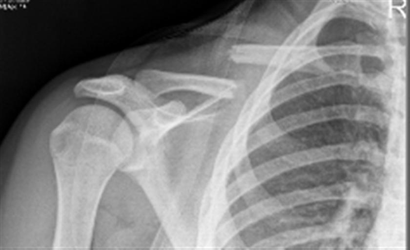 clavicle-fracture-1