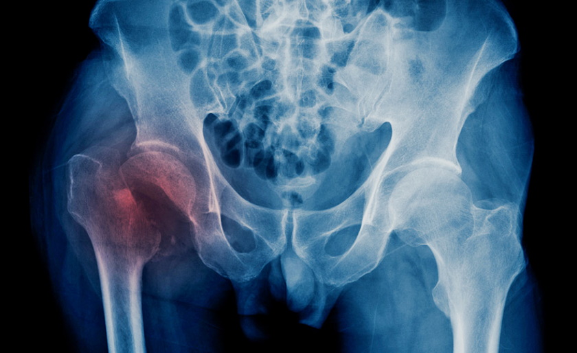 dt_180723_hip_fracture_x_ray_800x600