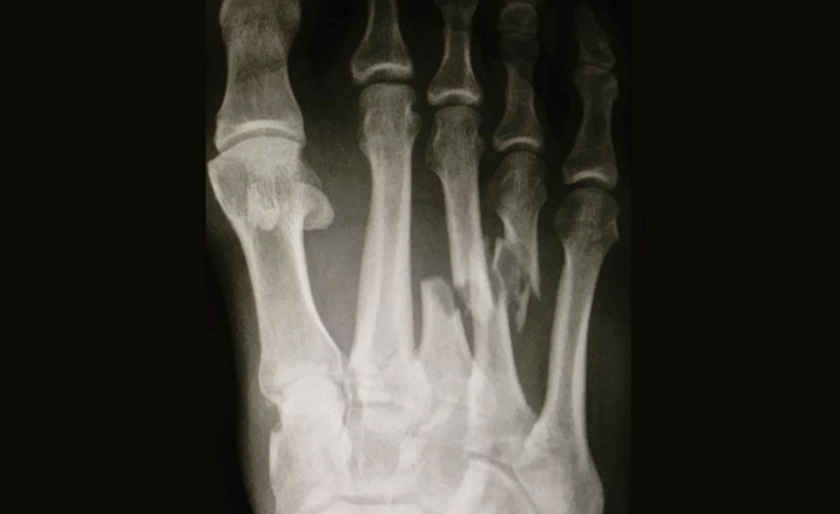 the-lisfranc-tear-examining-kelly-slaters-extreme-foot-injury-web